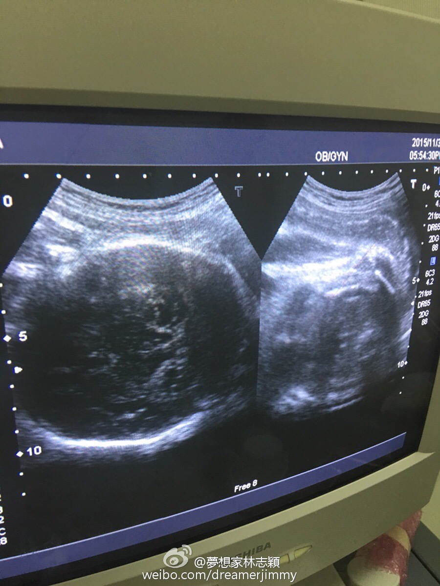 日前林志穎才陪過太太去做產檢,今日就剖腹產下孖仔。(微博圖片)