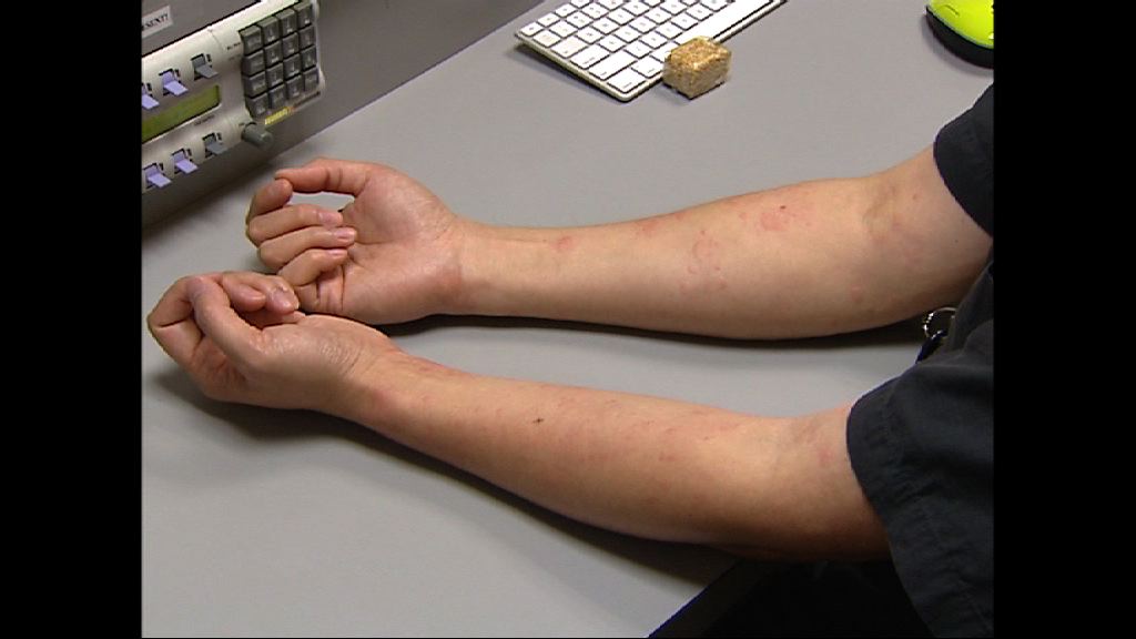 過敏學會指約兩成人曾患蕁麻疹