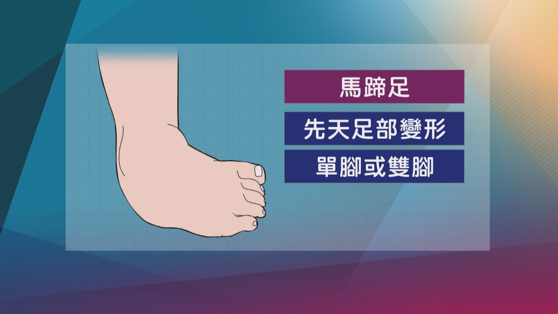 【杏林在線】馬蹄足寶寶的治療之旅