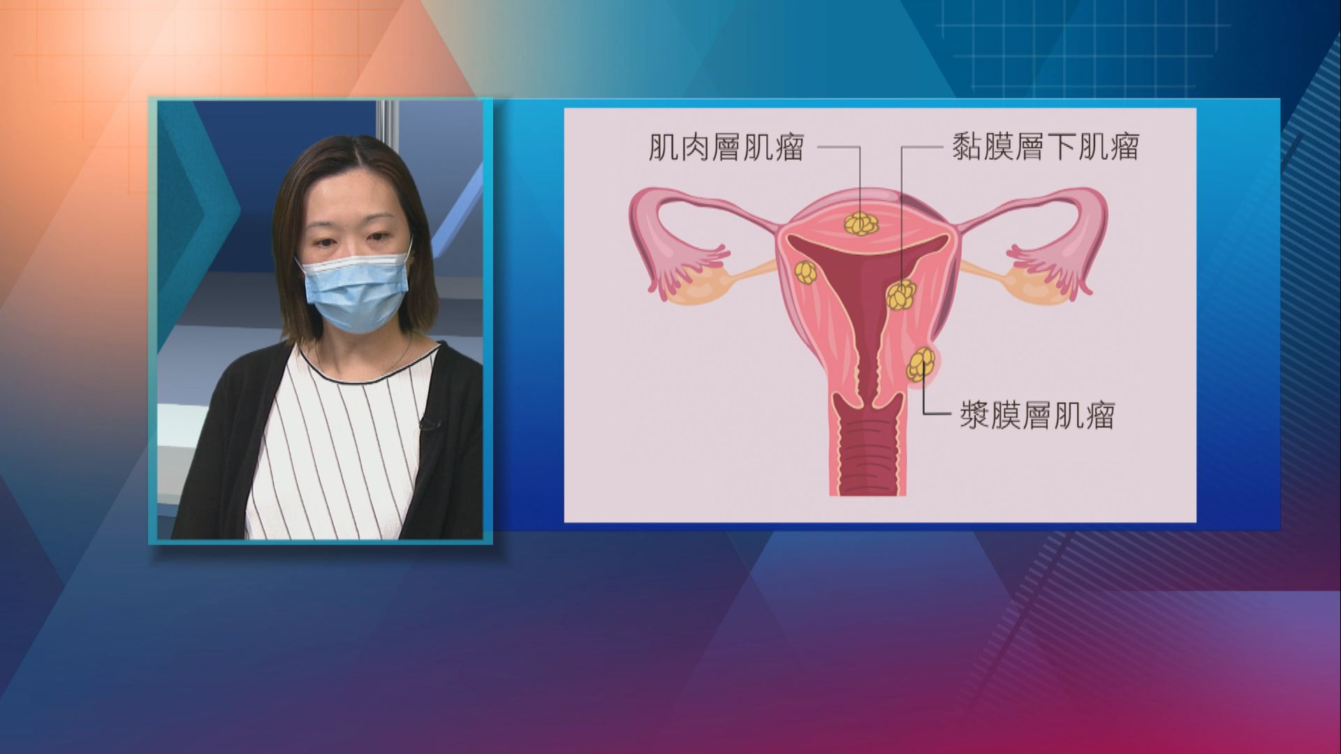 【杏林在線】認識子宮肌瘤