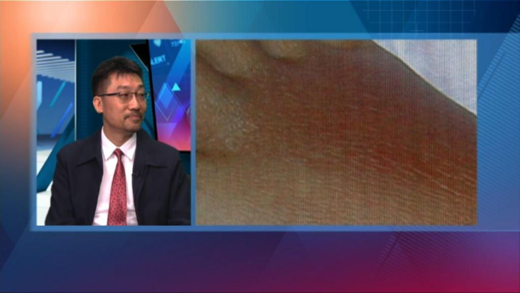 【杏林在線】治療耐藥性金黃葡萄球菌新發現
