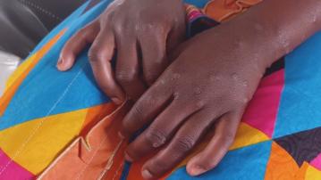 世衛表示猴痘不再構成國際關注的突發公共衞生事件